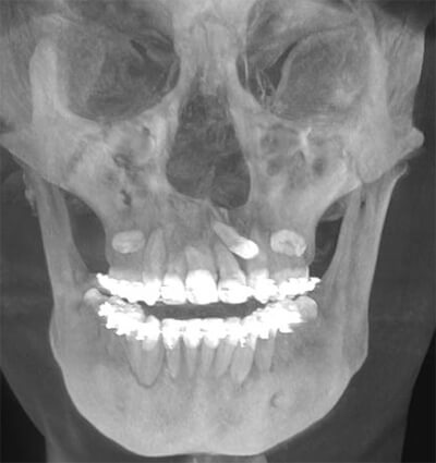 Fig. 8 Corte coronal