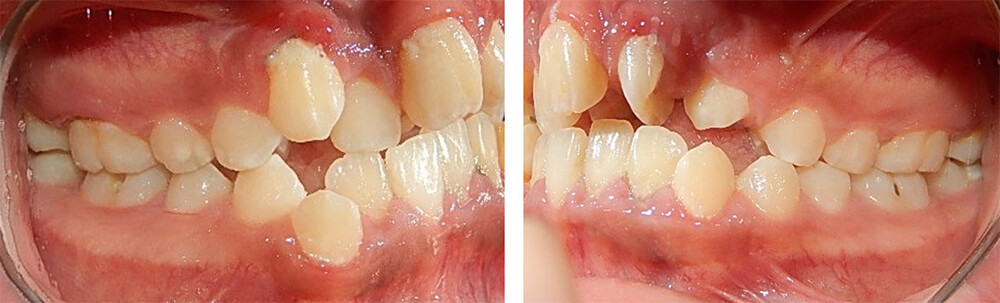 Fig. 10 lateral derecha  e izquierda clase II molar bilateral