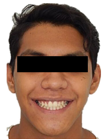 Fig. 10 Extraoral final frente sonriendo