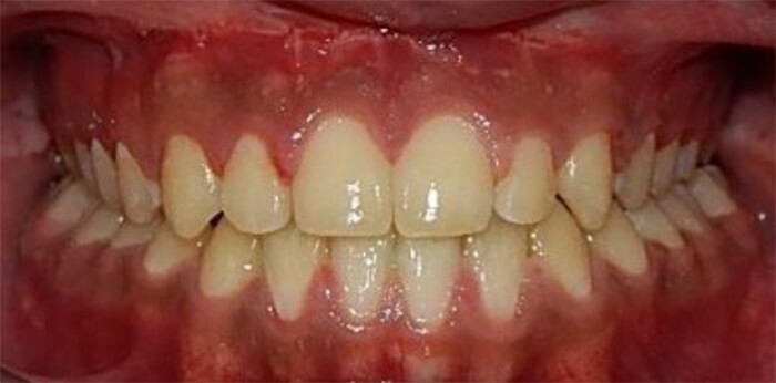 Fig. 12 Intraoral final