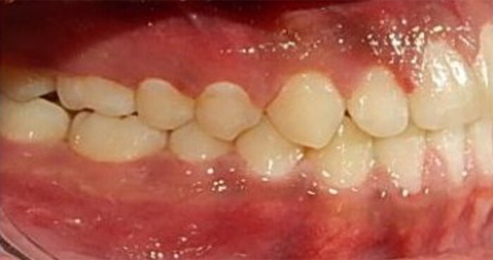 Fig. 13 Intraoral final derecha