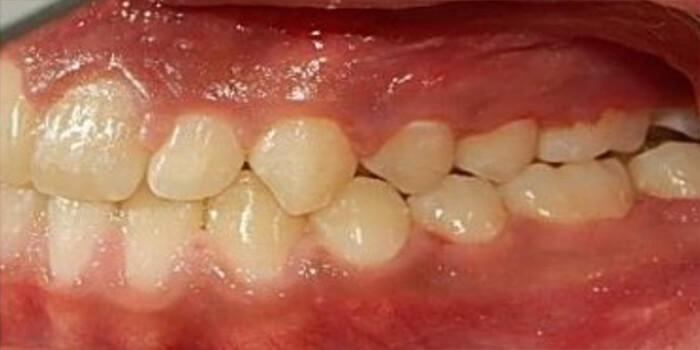 Fig. 14 Intraoral final izquierda