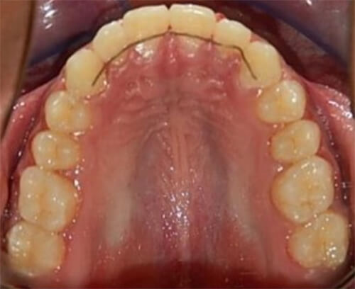 Fig. 15 Oclusal superior