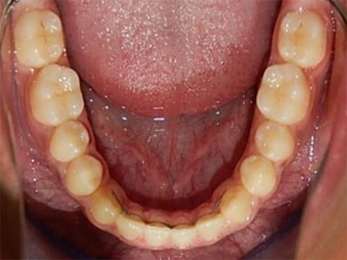 Fig. 16 Oclusal inferior