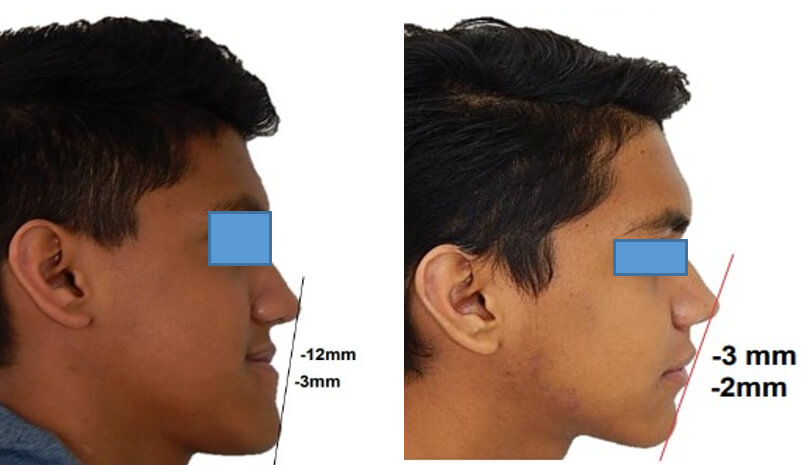 Fig. 18 comparativo inicio y final de perfil