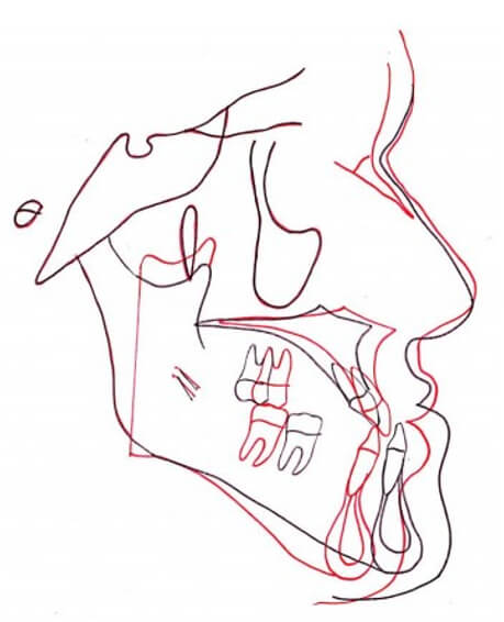 Fig. 20 Sobreimposición inicio-final