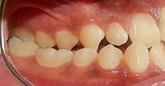 Fig. 4 intraoral derecha