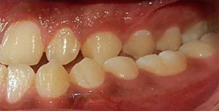 Fig. 5 Intraoral izquierda