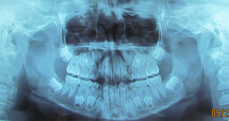 Figura 3. Radiografía panorámica