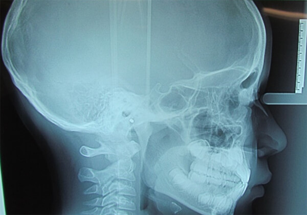 Figura 4.1. Radiografia Lateral de craneo