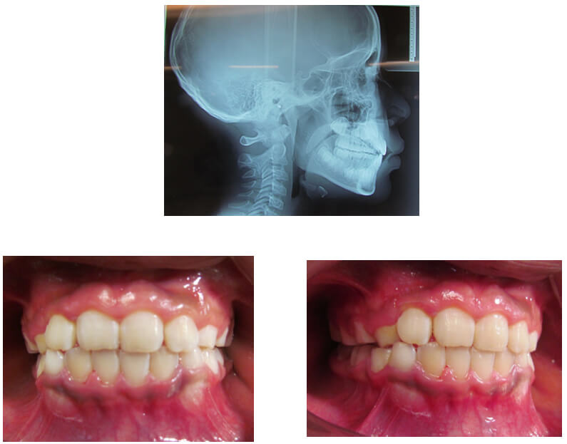 Figura 8. Radiografía Lateral y fotografías intraorales Mayo 2018