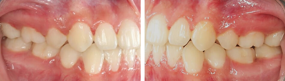 Fig. 10. lateral derecha e izquierda