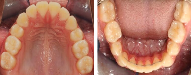 Fig. 11 oclusal superior e inferior