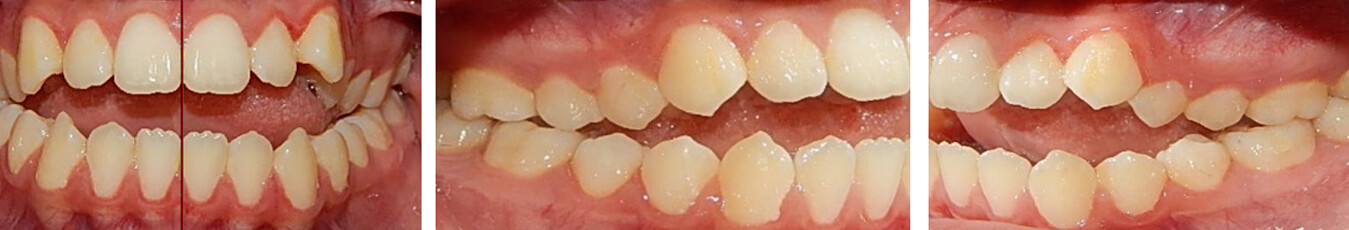 Fig 2. Intraoral de frente, lateral derecha e izquierda