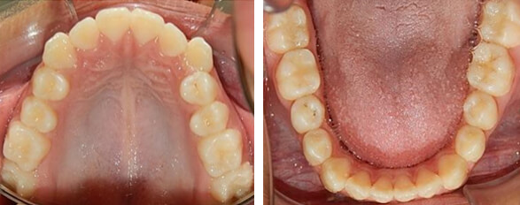 Fig 3. oclusal superior e inferior