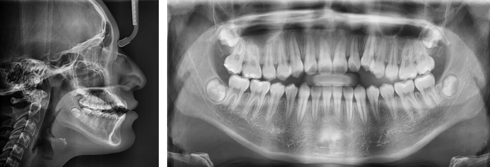 Fig. 4. Radiografía cefálica lateral y  panorámica