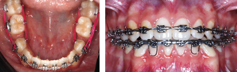 Fig.6 vista oclusal y frente 