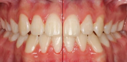 Fig.8  Comparación inicio  sonrisa final