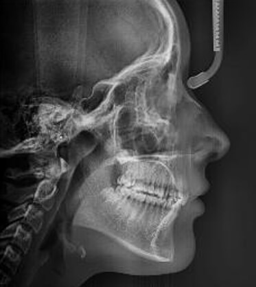 Fig.10 Radiografía lateral de cráneo final