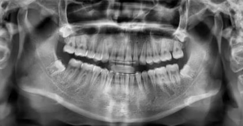 Fig.11 Radiografía panorámica final