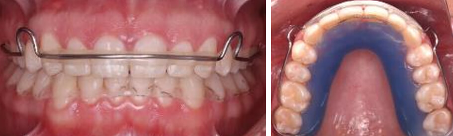 Fig.12 Intraoral de frente y oclusal con retenedores