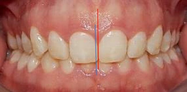 Fig.3 Intraoral de frente inicio