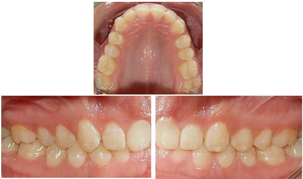 Fig.4 oclusal superior,  laterales derecho  izquierda