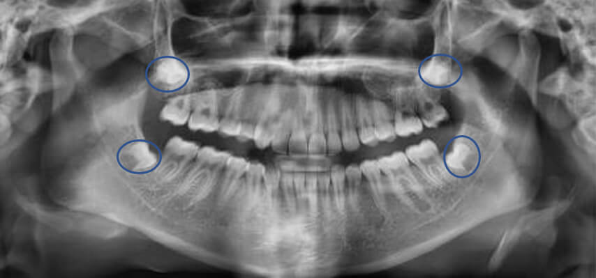 Fig.6 Radiografía panorámica inicio