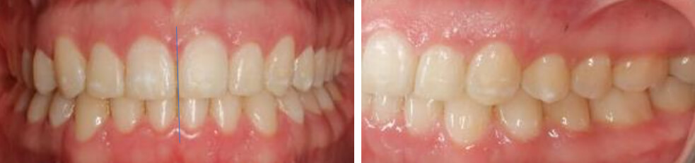 Fig. 9 Intraoral frente, lateral izquierda final