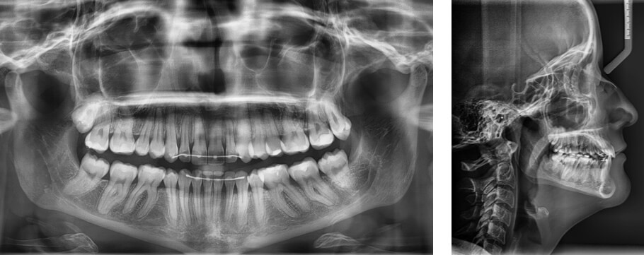 Fig. 11 Radiografía panorámica, lateral de cráneo