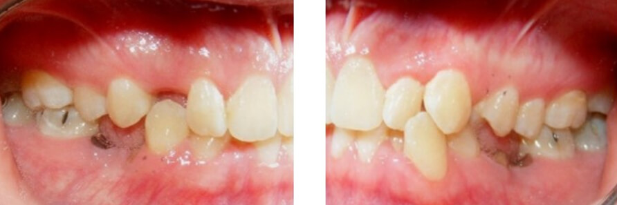 Fig. 3 relación molar Clase I bilateral y clase canina derecha no determinada  y clase I izquierda. 