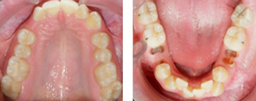 Fig. 4.  Vista oclusal en la inferior los restos radiculares de los OD. 75 y 85   la agenesia del 35 y 45