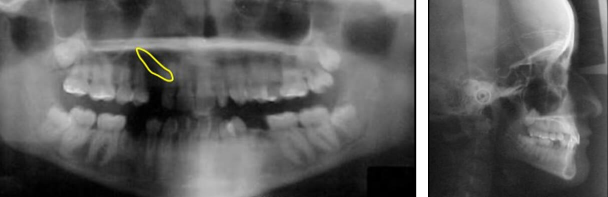 Fig. 5. Color amarillo O.D. 13 impactado,  lateral de cráneo.