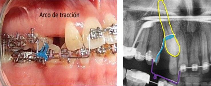 Fig. 7 arco de tracción en acero 0.017x0.025