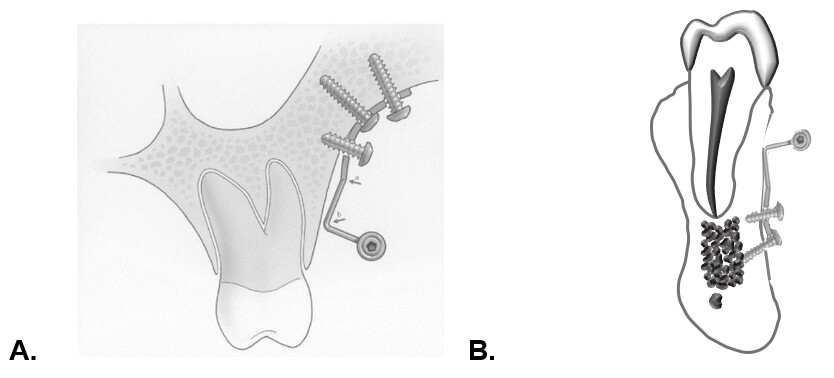 Figura. 1. A. Corte esquemático de una miniplaca y sus 3 porciones, colocada sobre la cresta infracigomática11. B. Corte esquemático de una miniplaca y sus 3 porciones, colocada entre el canino y premolar inferior en la sínfisis mandibular.