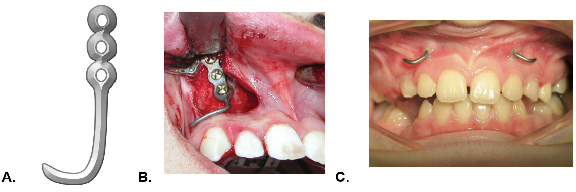 Figura 2. A. Miniplaca de titanio con extremo distal modificable B. Fotografía clínica donde se puede observar la miniplaca instalada en la pared nasal lateral del maxilar 13. C. Fotografía clínica, donde los extremos distales de las miniplacas están doblados hacia distal 10. 