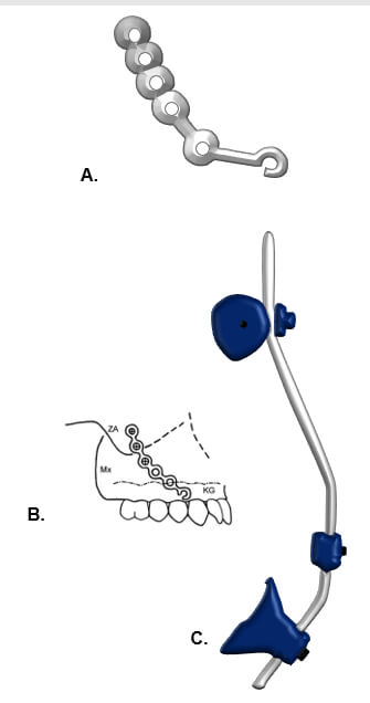 Figura 3. A. Miniplaca curvilínea B. Miniplaca curvilínea, se dobla a la superficie ósea del contrafuerte infracigomático, fijada con tres minitornillos autorroscantes 14. C. Máscara facial de Petit.