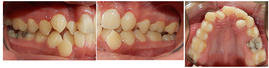 Fig. 1 Intraoral derecha izquierda oclusal superior