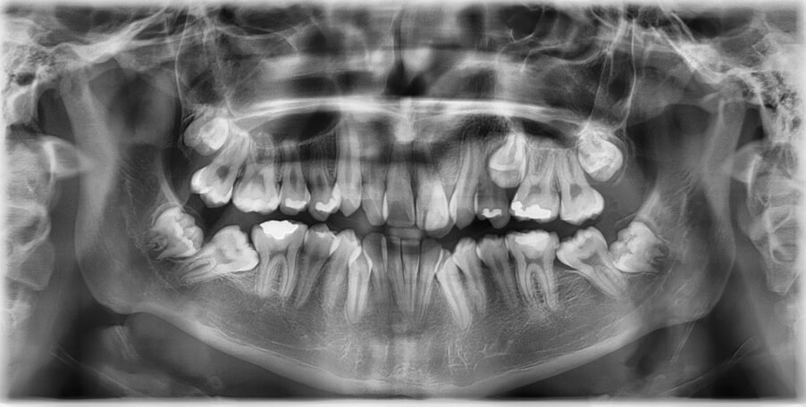 Fig.4 Radiografía Panorámica