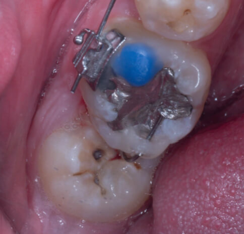 Fig.5 Mecánica de verticalización de molares inferiores