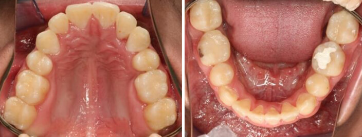 Fig. 6 Oclusal superior inferior final