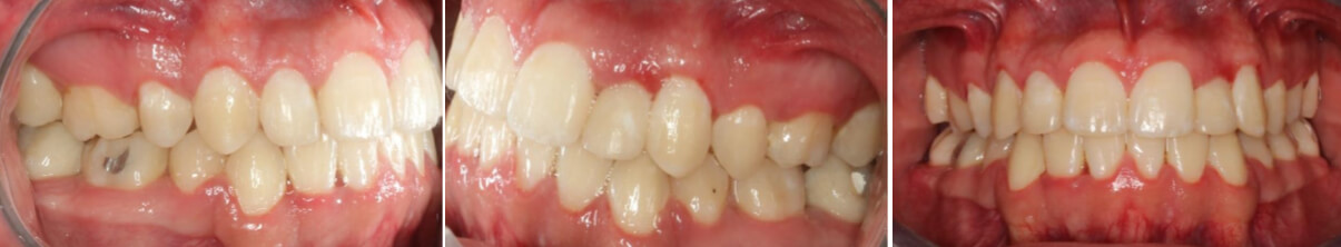 Fig. 7 Intraoral derecha, izquierda frente final