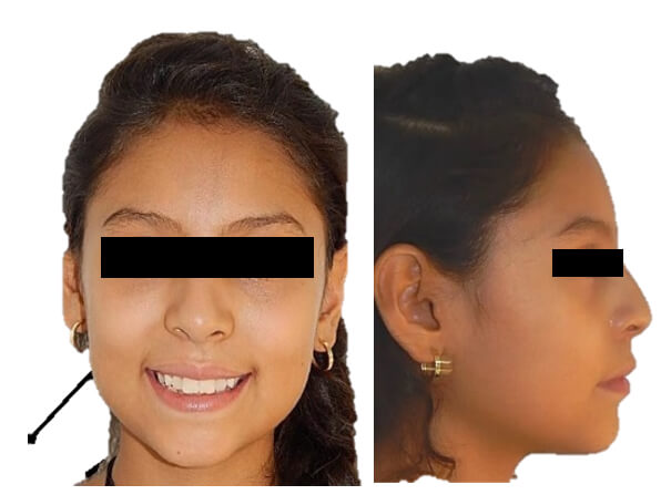 Fig.1 Extraoral frente sonrisa inicio, perfil