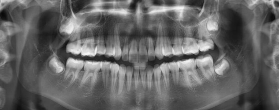 Fig.10 Radiografía Panorámica final