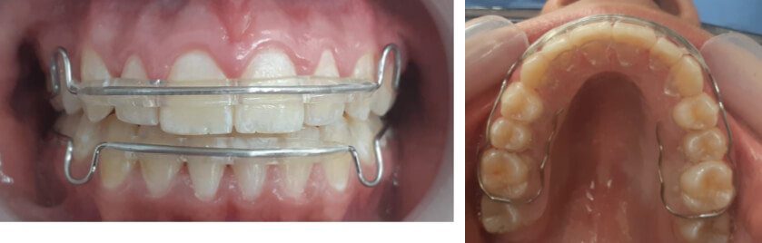 Fig.11 frente con retenedores y oclusal