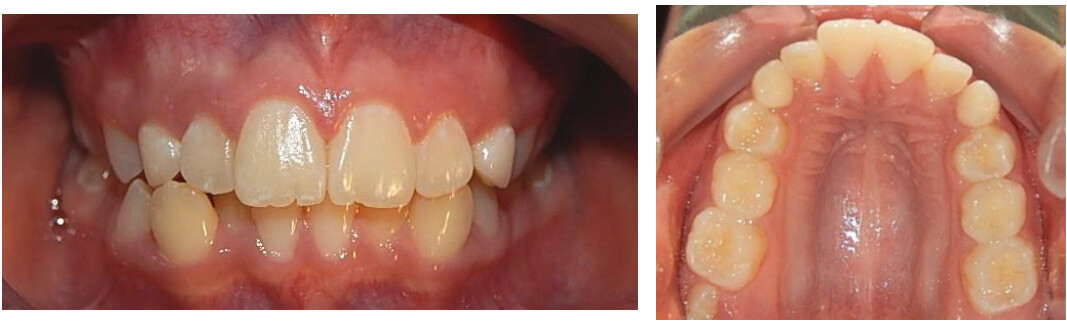 Fig.2 Intraoral de frente inicio, oclusal superior