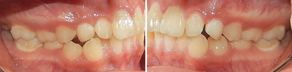 Fig.3 lateral derecha e izquierda inicio