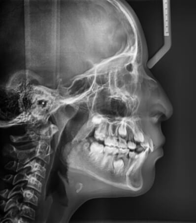 Fig.4 Radiografía lateral de cráneo inicio