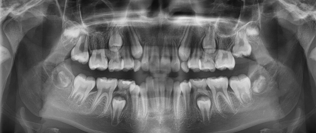 Fig.5 Radiografía panorámica inicio