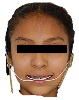 Fig. 6 Intraoral oclusal progreso